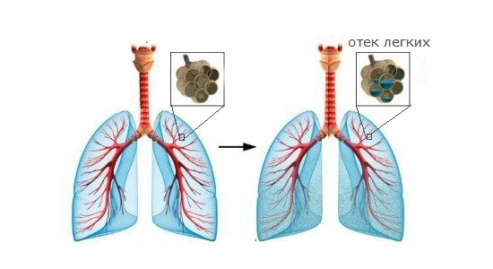 Отек легких Отек легких