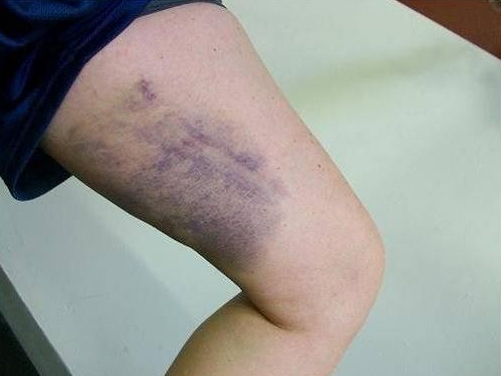 Отек при растяжении мышц бедра Отек при растяжении мышц бедра