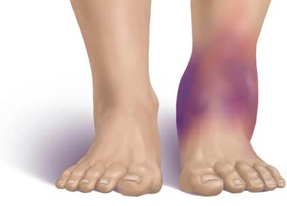 Отек при растяжении сустава