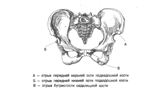 Открытые переломы подзвдошной кости Открытые переломы подзвдошной кости