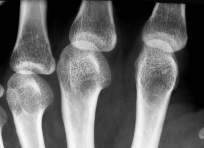 Остеопороз на рентгене Остеопороз на рентгене