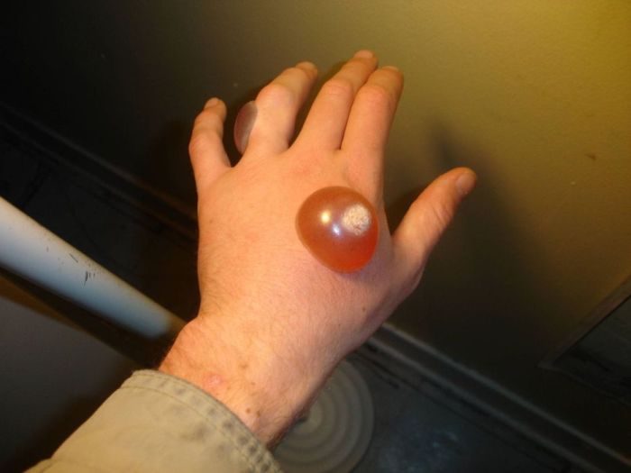 Ожог жидким азотом 2 степени Ожог жидким азотом 2 степени