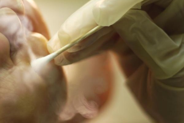 Ожоги которые оставляет жидкий азот