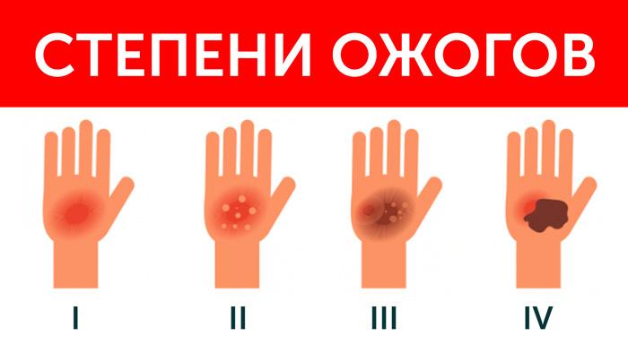 Степени ожогов Степени ожогов
