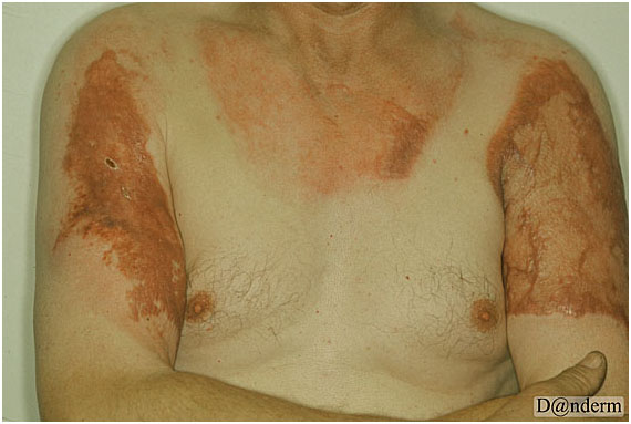 После каких ожогов остаются шрамы