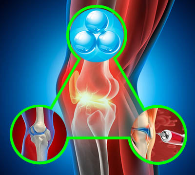 Озонотерапия суставов