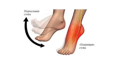 Падающая стопа Падающая стопа