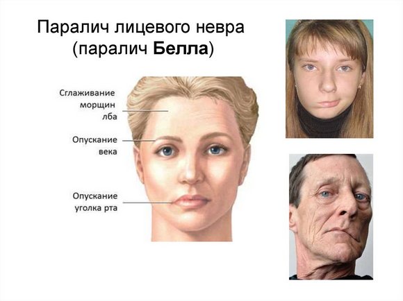Паралич лица Паралич лица