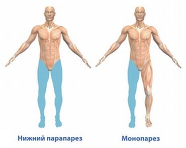 Паралич нижних конечностей Паралич нижних конечностей