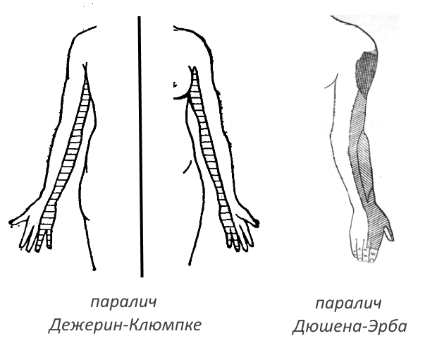 Паралич при плексите Паралич при плексите