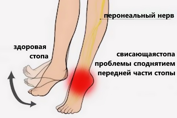 Парез стопы Парез стопы