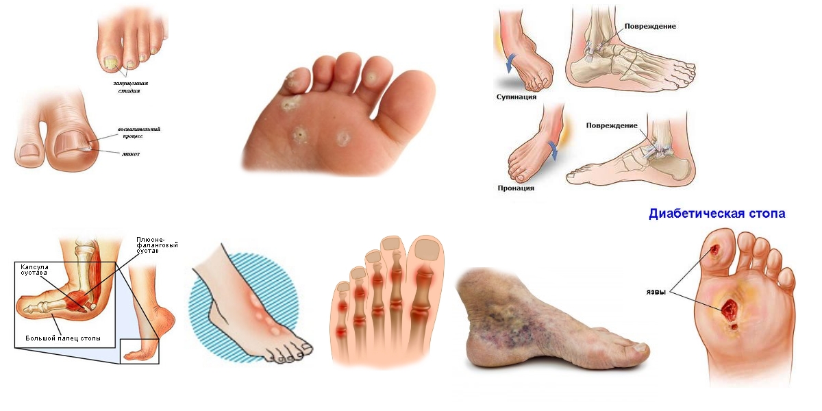 Патологии стопы Патологии стопы