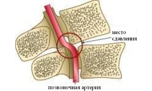 Нарушение кровоснабжения при радикулите Нарушение кровоснабжения при радикулите