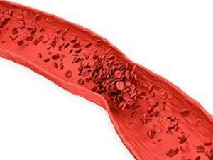 Передавливание сосудов