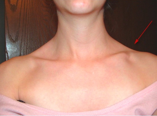 Деформация ключицы Деформация ключицы