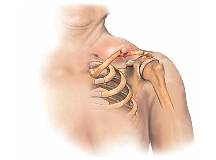 Перелом ключицы Перелом ключицы