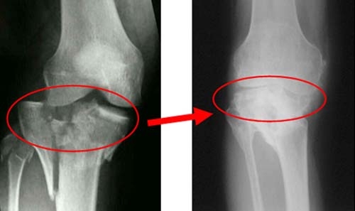 Рентген снимок перелома коленного сустава Рентген снимок перелома коленного сустава
