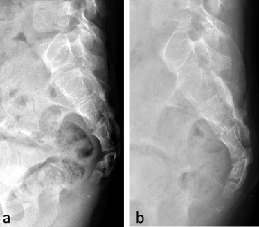 Перелом копчика на рентген снимке Перелом копчика на рентген снимке