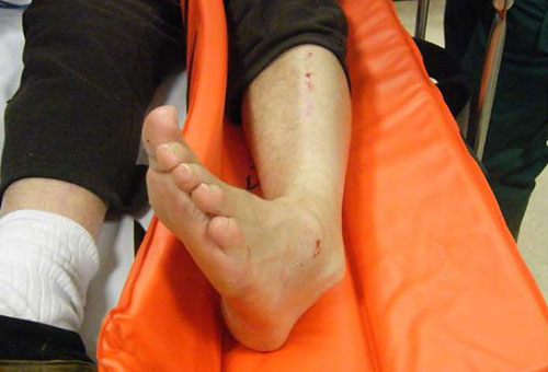 Смещение кости при переломе