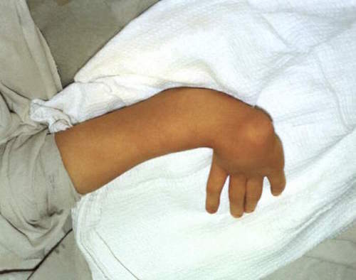 Перелом лучевой кости со смещением