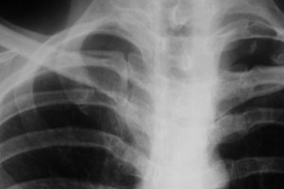 Перелом на рентген снимке