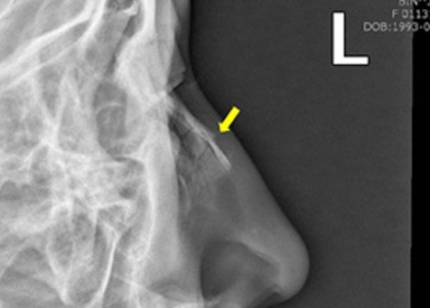 Перелом носа на рентген снимке Перелом носа на рентген снимке