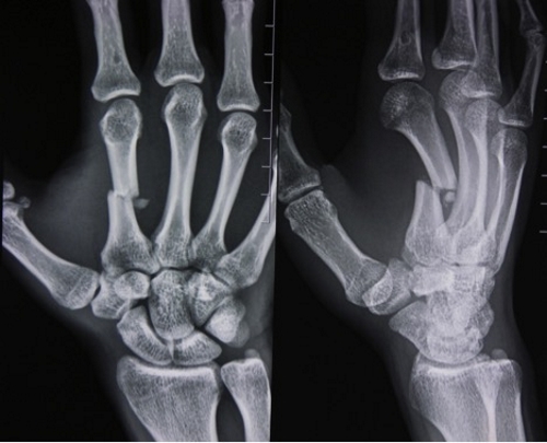 Перелом пястной кости кисти на рентген снимке Перелом пястной кости кисти на рентген снимке