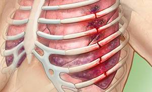 Перелом ребер Перелом ребер