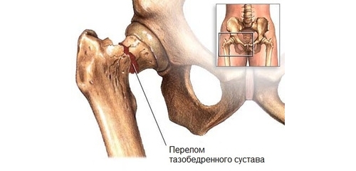 Перелом шейки бедра Перелом шейки бедра