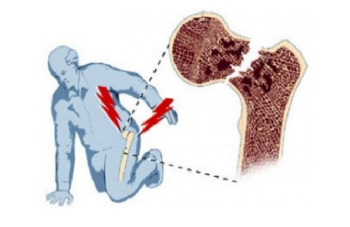Перелом шейки бедра
