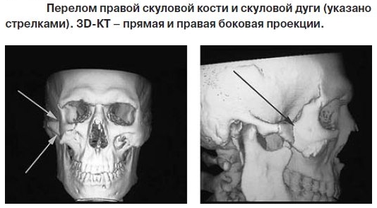 Перелом скуловой кости на КТ снимке