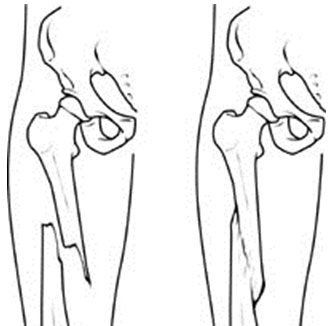 Перелом со смещением кости Перелом со смещением кости