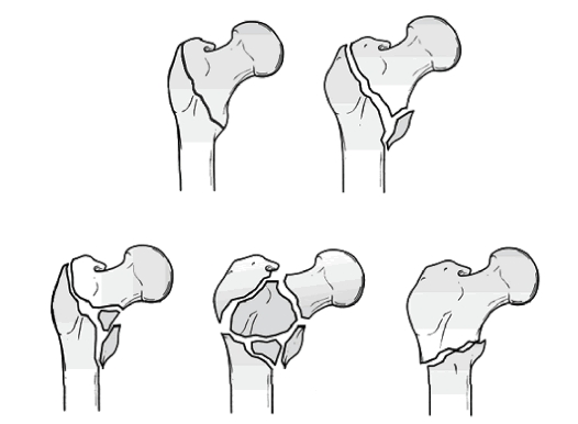 Переломы бедренной кости Переломы бедренной кости