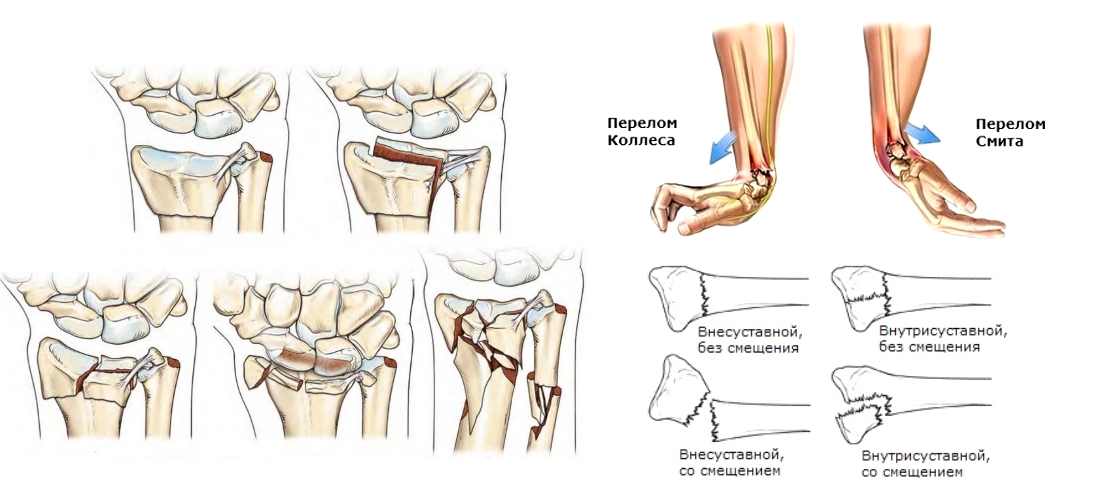 Варианты переломов кисти Варианты переломов кисти