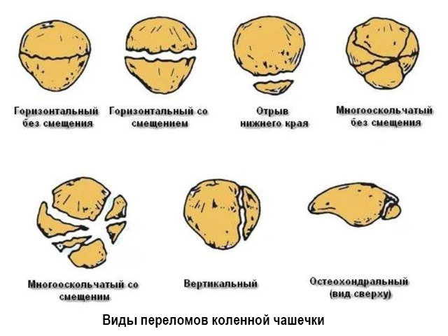 Переломы коленной чашечки
