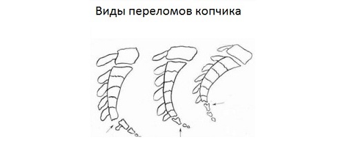 Переломы копчика Переломы копчика