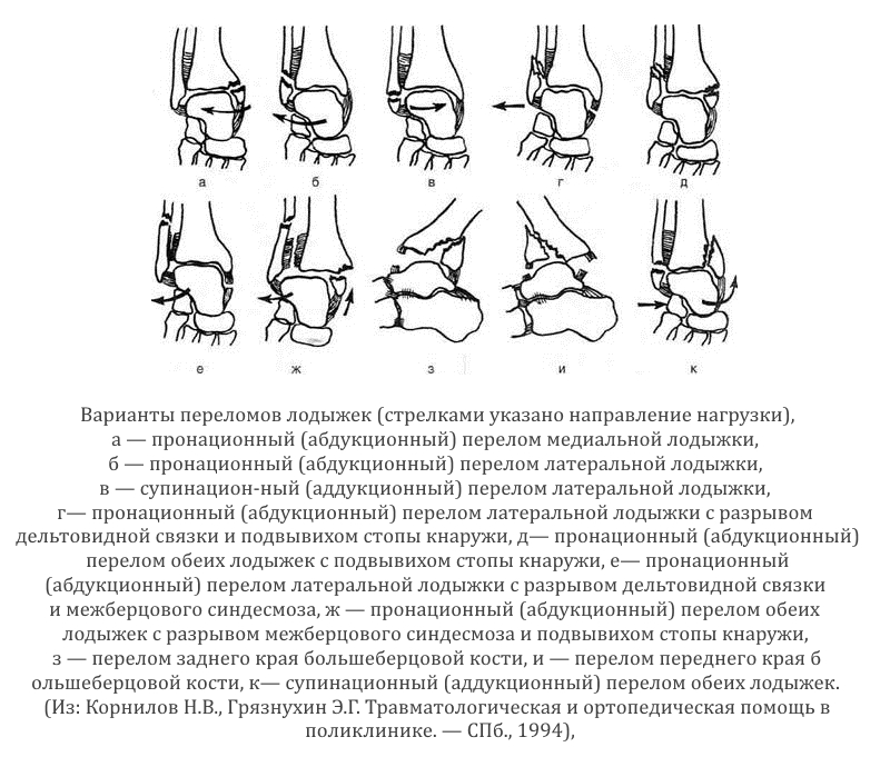 Переломы лодыжек по степени пронации Переломы лодыжек по степени пронации