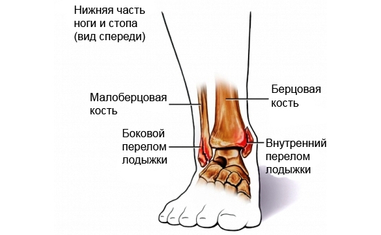 Виды переломов голеностопа и лодыжки Виды переломов голеностопа и лодыжки