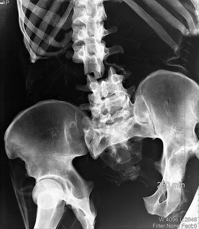 Перелом спины Перелом спины