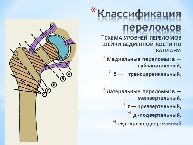 Переломы верхней части бедренной кости Переломы верхней части бедренной кости