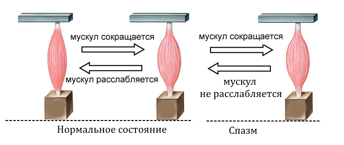 Перенапряжение или спазм мышц Перенапряжение или спазм мышц