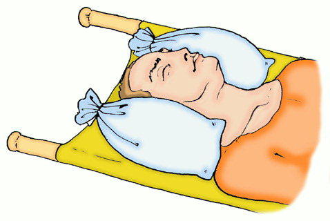 Переноска при травме шеи Переноска при травме шеи