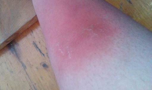 Периостит голени Периостит голени