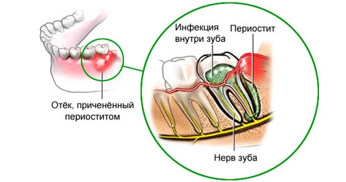 Периостит на фоне кариеса Периостит на фоне кариеса