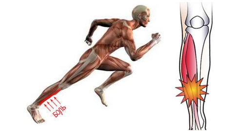 Периостит при нагрузках на голень Периостит при нагрузках на голень