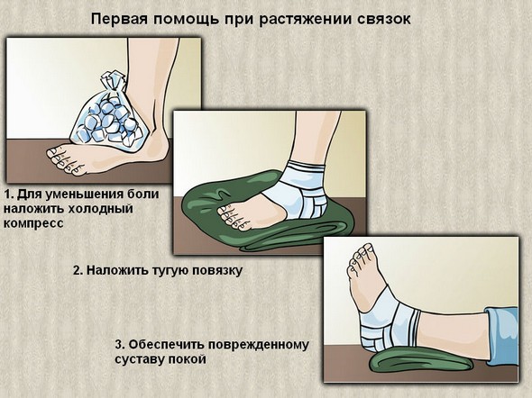 Первая помощь при растяжении связок голеностопа
