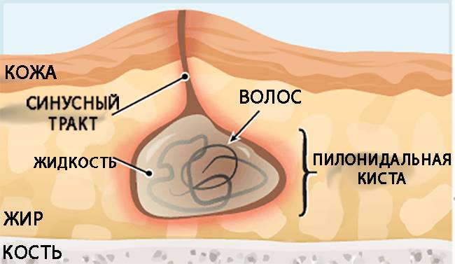Пилонидальная киста копчика Пилонидальная киста копчика