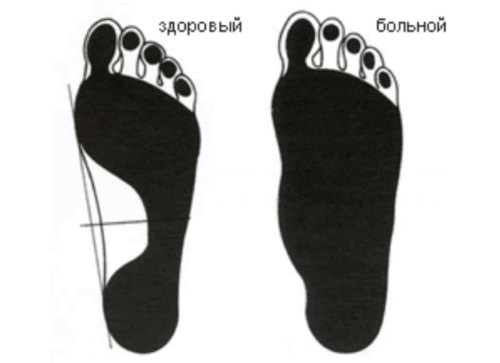 Плантография стопы для определения вальгусной деформации Плантография стопы для определения вальгусной деформации