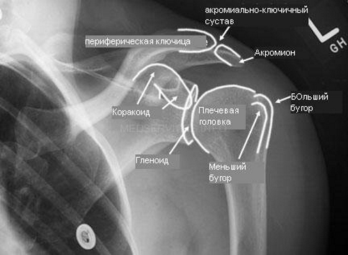 Плечевой сустав на рентген снимке Плечевой сустав на рентген снимке