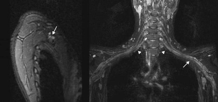Диагностика плексита на МРТ Диагностика плексита на МРТ